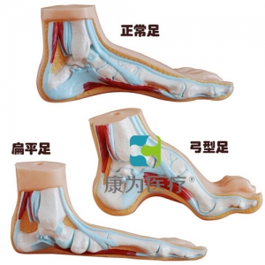 “康為醫(yī)療”正常足、扁平足、弓型足模型