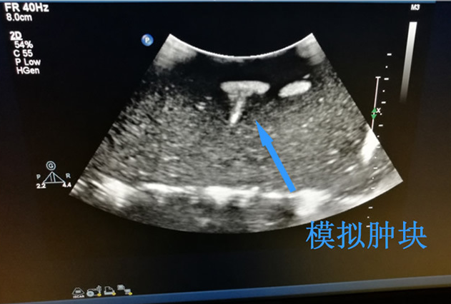 超聲引導(dǎo)下頸部體表腫塊活檢模塊